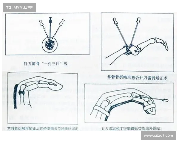 骨折治疗的新进展与康复方法探索：从早期干预到个性化恢复策略